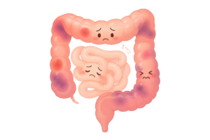 病気の大腸と小腸のイラスト｜消化器トラブル・腸内環境の医療素材（透過PNG・商用OK）