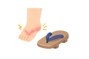 下駄で靴ずれした足のイラスト｜鼻緒による擦り傷・足トラブル素材（透過PNG・商用OK）