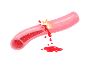 血管が破れて出血するイラスト｜血管損傷・内出血・医療解説素材（透過PNG・商用OK）
