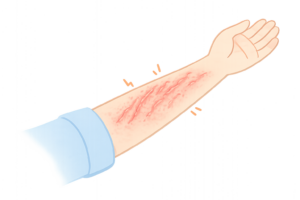 引っかき傷でミミズ腫れになった腕のイラスト｜皮膚トラブル・かゆみ・炎症素材（透過PNG・商用OK）